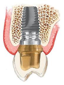 implant