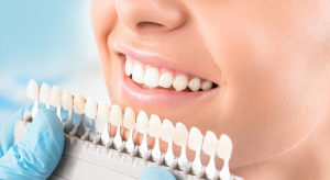 blanchiment-dentaire