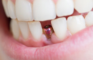 pose d'implant dentaire