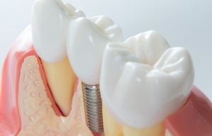 pose de couronne dentaire