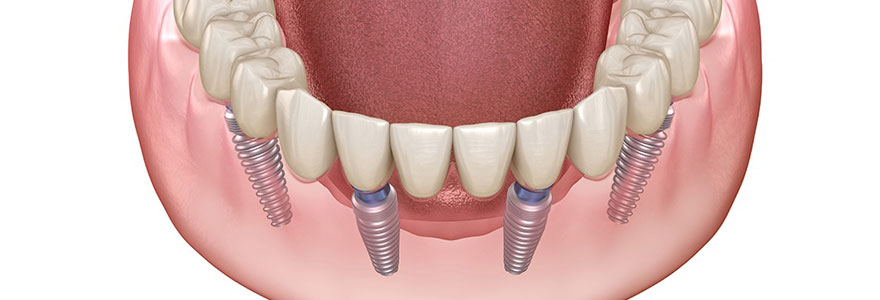 prothèse dentaire all in 4